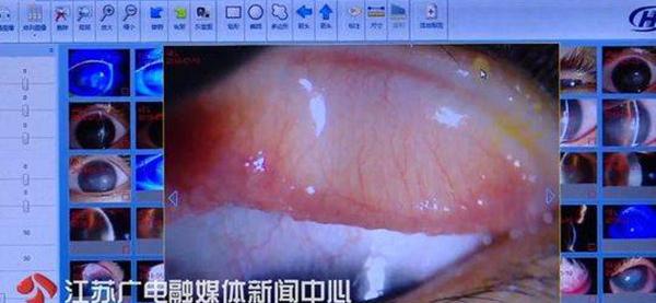 14岁少女戴网购隐形眼镜，感染寄生虫差点失明